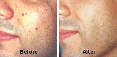 Pigmented Lesions laser result