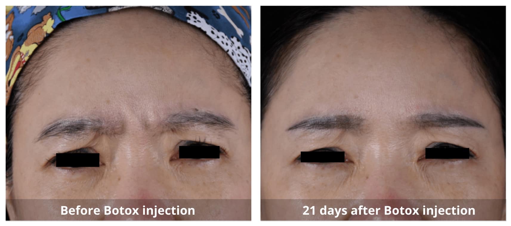 Botox Before and After-2-Sunshine-Kitchener-Waterloo-Cosmetic-Clinic-And-Medical-Spa