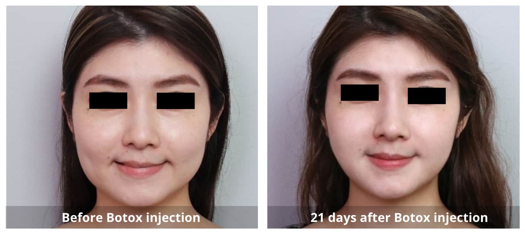 Botox Before and After-3-Sunshine-Kitchener-Waterloo-Cosmetic-Clinic-And-Medical-Spa