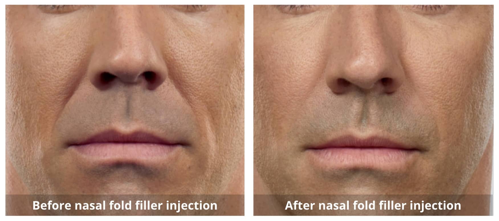 Dermal Fillers Before and After-3-Sunshine-Kitchener-Waterloo-Cosmetic-Clinic-And-Medical-Spa