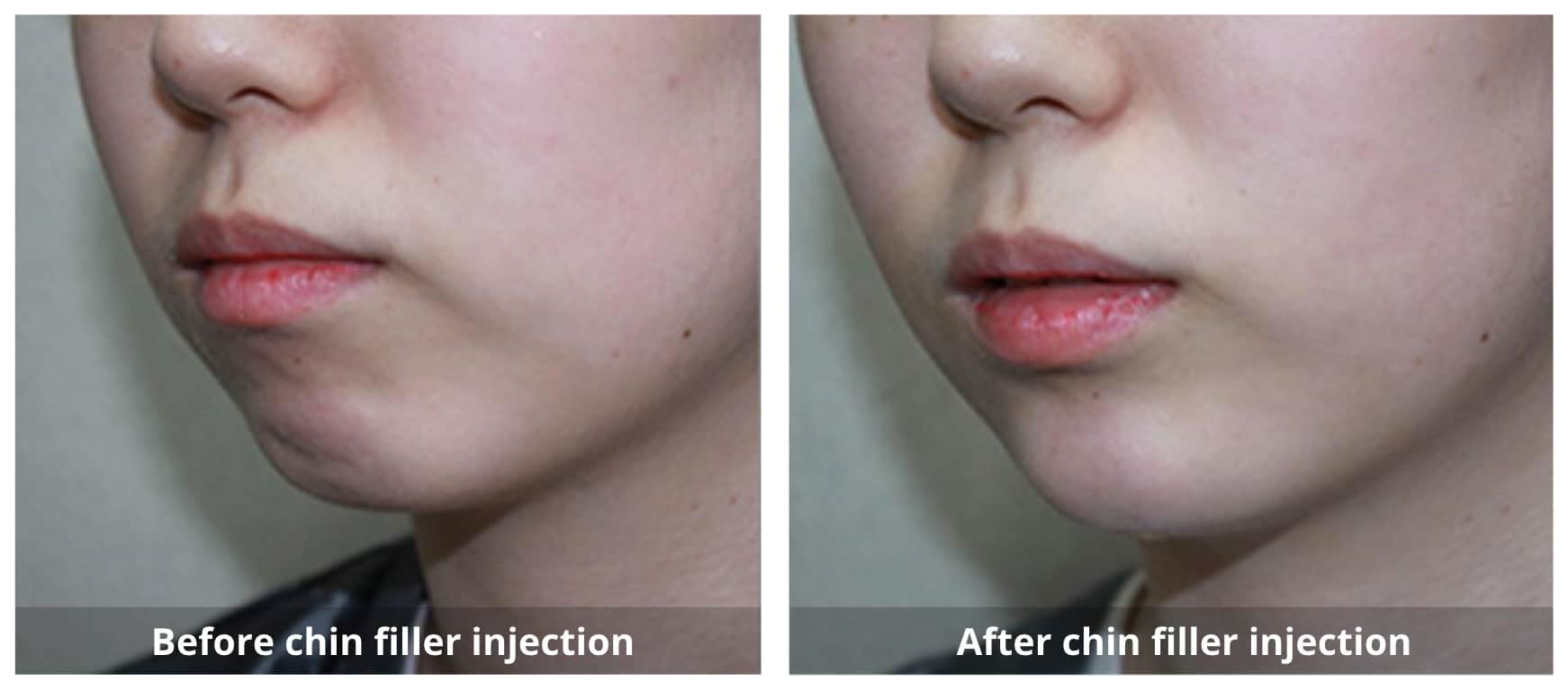Dermal Fillers Before and After-5-Sunshine-Kitchener-Waterloo-Cosmetic-Clinic-And-Medical-Spa