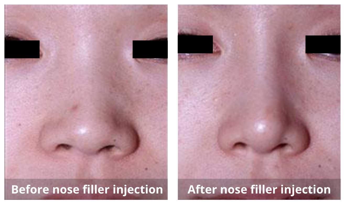 Dermal Fillers Before and After-6-Sunshine-Kitchener-Waterloo-Cosmetic-Clinic-And-Medical-Spa