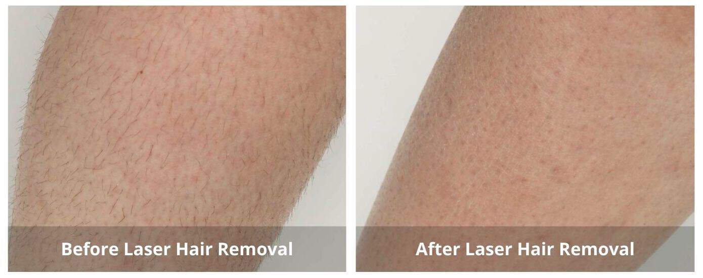 Laser Hair Removal Waterloo, Kitchener Hair Removal Near Me