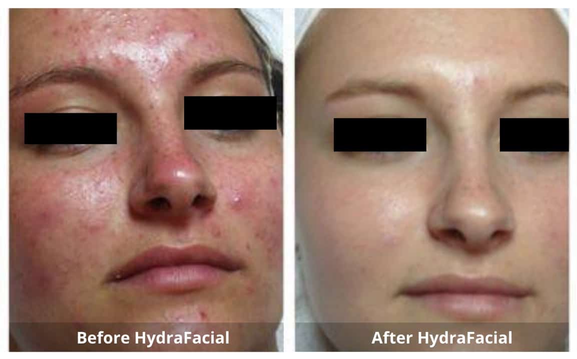 HydraFacial Before and After-1-Sunshine-Kitchener-Waterloo-Cosmetic-Clinic-And-Medical-Spa