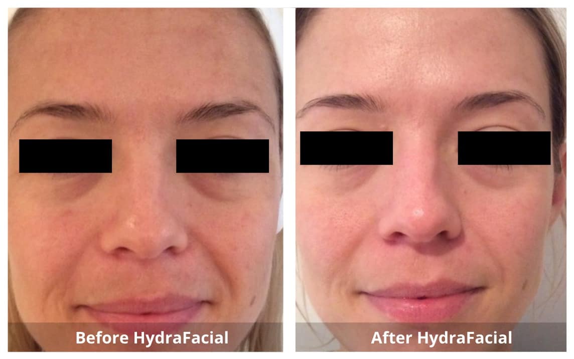 HydraFacial Before and After-2-Sunshine-Kitchener-Waterloo-Cosmetic-Clinic-And-Medical-Spa
