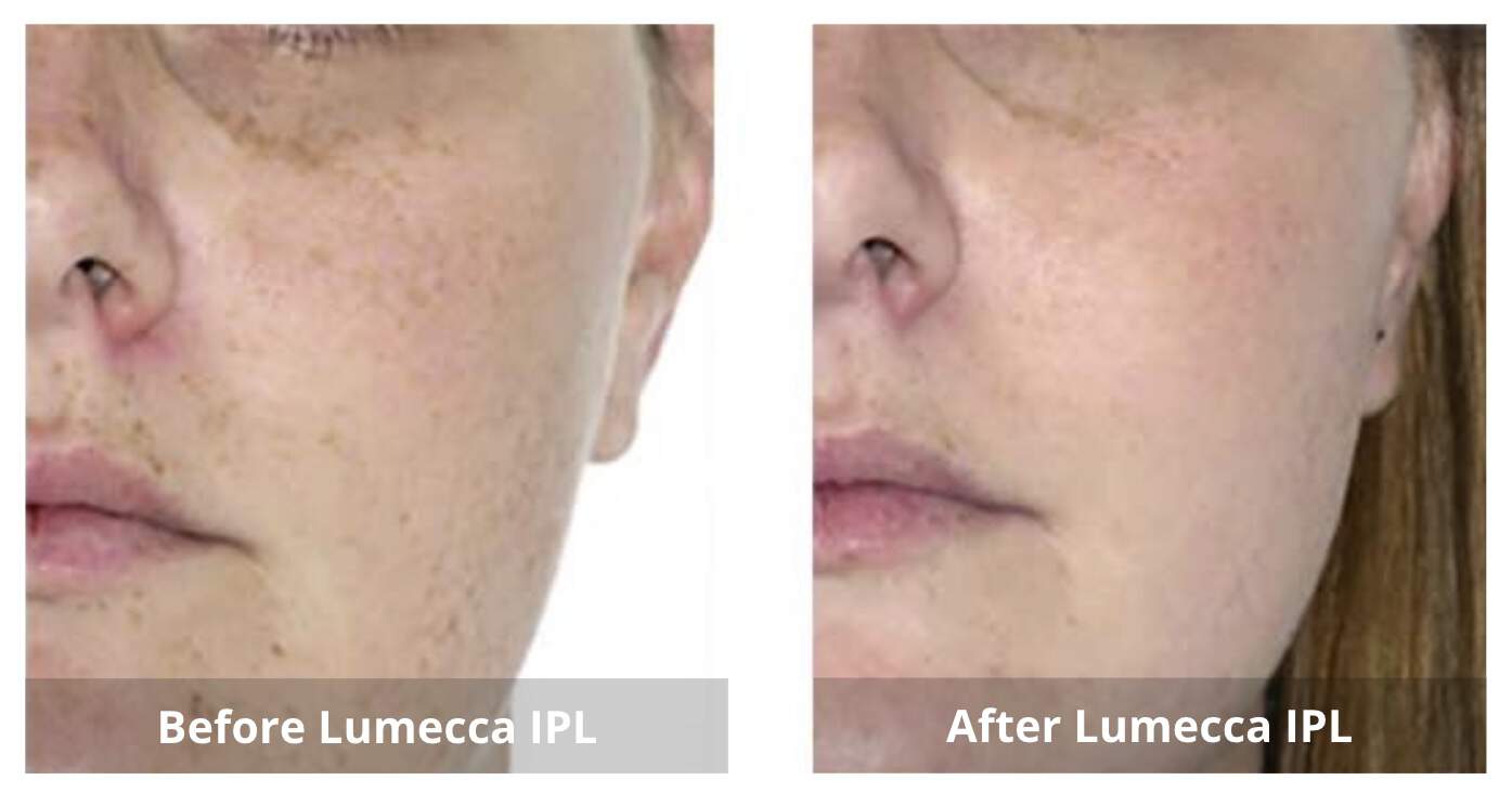 Lumecca IPL Before and After 1-Sunshine-Kitchener-Waterloo-Cosmetic-Clinic-And-Medical-Spa