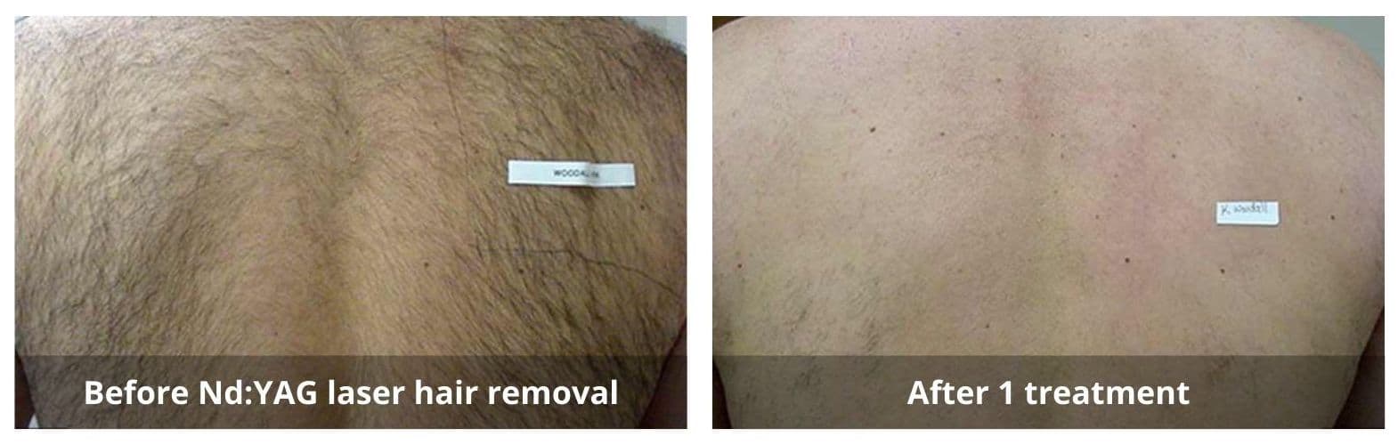 We offer laser hair removal waterloo kitchener services. Check the laser hair removal before and after pictures!