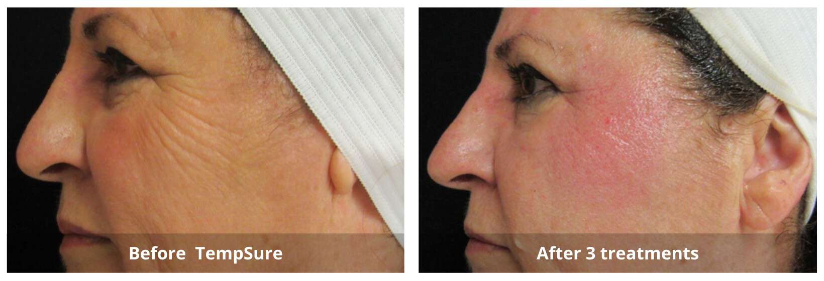 TempSure Skin Tightening Before and After 3-Sunshine-Kitchener-Waterloo-Cosmetic-Clinic-And-Medical-Spa
