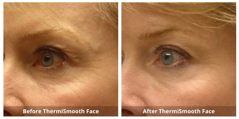 ThermiSmooth Before and After-1-Sunshine-Kitchener-Waterloo-Cosmetic-Clinic-And-Medical-Spa