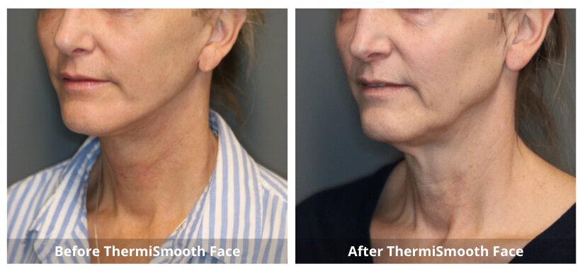 ThermiSmooth Before and After-2-Sunshine-Kitchener-Waterloo-Cosmetic-Clinic-And-Medical-Spa