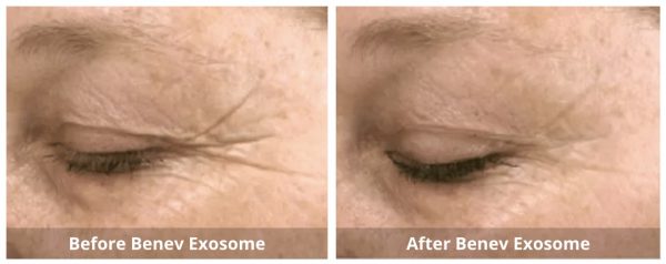 Benev Exosome Skin Booster B&A 1_Sunshine Kitchener-Waterloo-Cosmetic-Clinic-And-Medi-Spa