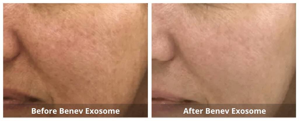 Benev Exosome Skin Booster B&A 2_Sunshine Kitchener-Waterloo-Cosmetic-Clinic-And-Medi-Spa