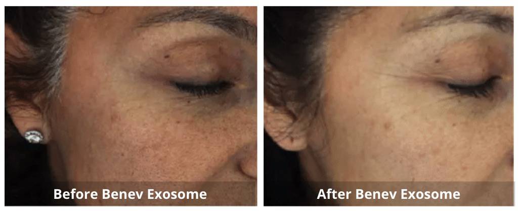Benev Exosome Skin Booster B&A 3_Sunshine Kitchener-Waterloo-Cosmetic-Clinic-And-Medi-Spa