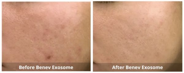 Benev Exosome Skin Booster B&A 4_Sunshine Kitchener-Waterloo-Cosmetic-Clinic-And-Medi-Spa