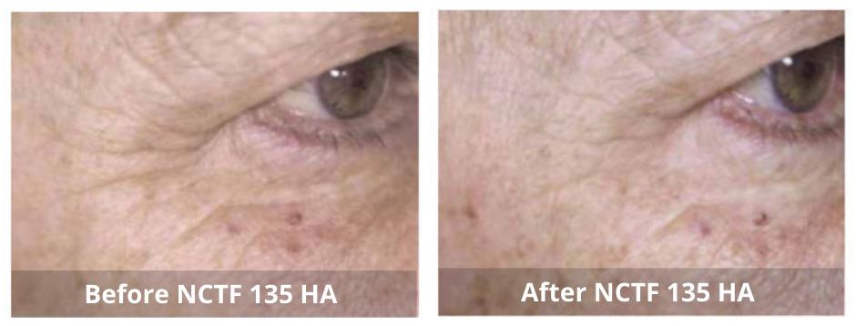 FillMed NCTF 135 HA Skin Booster B&A 2_Sunshine Kitchener-Waterloo-Cosmetic-Clinic-And-Medi-Spa