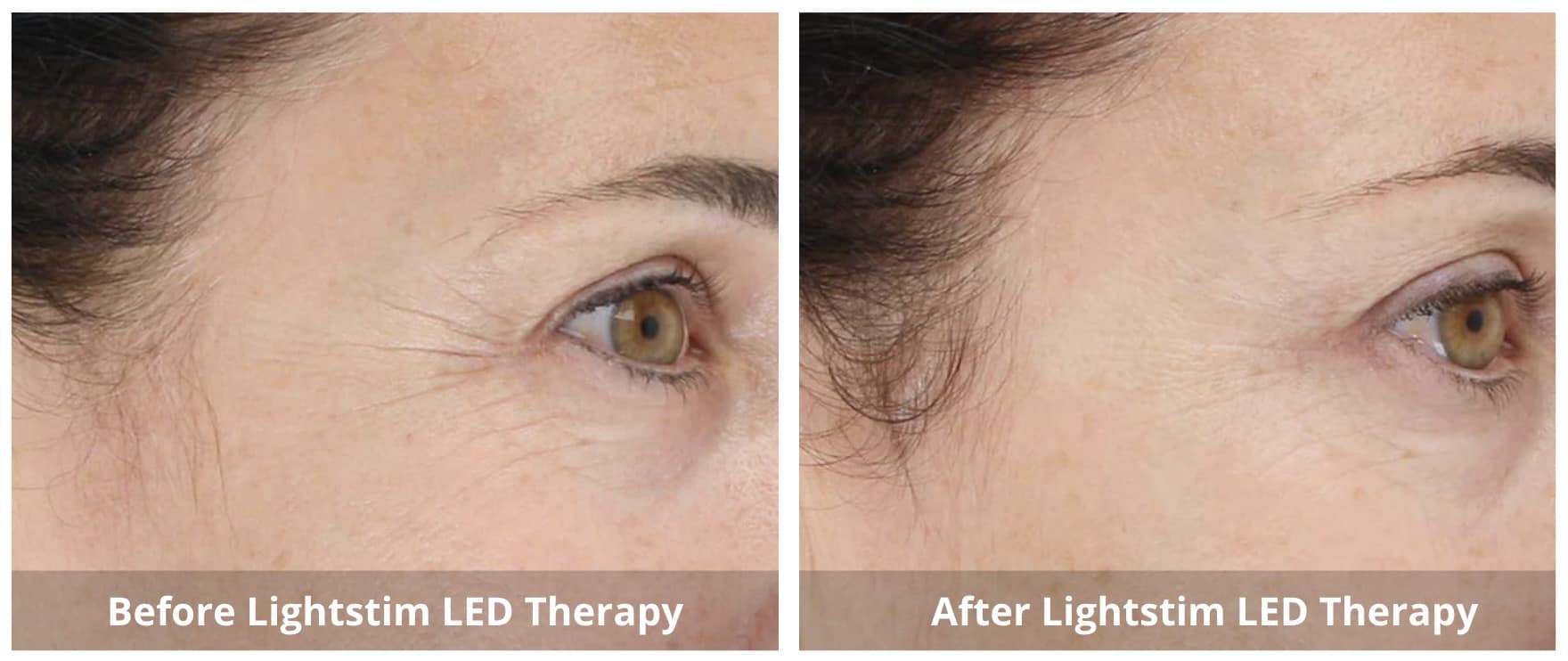 LightStim LED Therapy Before and After 1-Sunshine-Kitchener-Waterloo-Cosmetic-Clinic-And-Medical-Spa