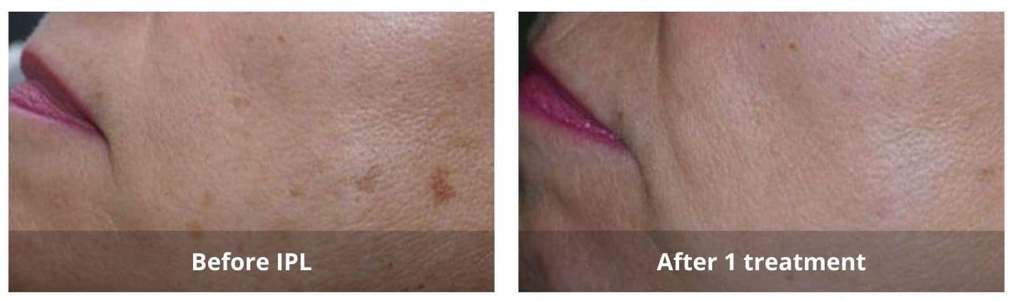 Lumecca IPL Before and After 1-Sunshine-Kitchener-Waterloo-Cosmetic-Clinic-And-Medical-Spa