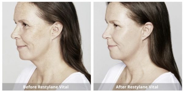 Restylane Vital Skin Booster B&A 1_Sunshine Kitchener-Waterloo-Cosmetic-Clinic-And-Medi-Spa