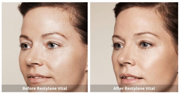 Restylane Vital Skin Booster B&A 2_Sunshine Kitchener-Waterloo-Cosmetic-Clinic-And-Medi-Spa