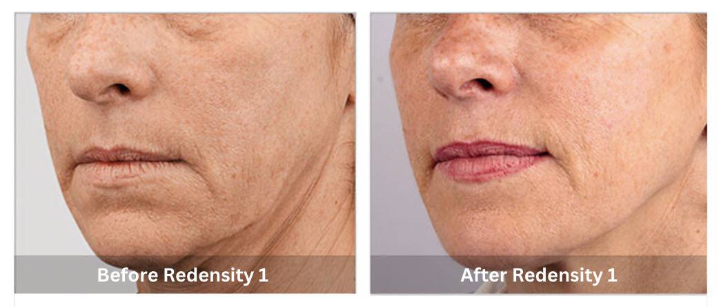 Teosyal Redensity 1 Skin Booster B&A 1_Sunshine Kitchener-Waterloo-Cosmetic-Clinic-And-Medi-Spa
