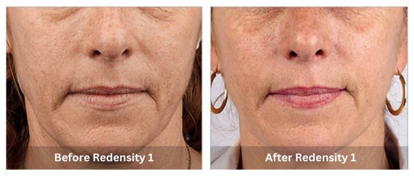 Teosyal Redensity 1 Skin Booster B&A 2_Sunshine Kitchener-Waterloo-Cosmetic-Clinic-And-Medi-Spa