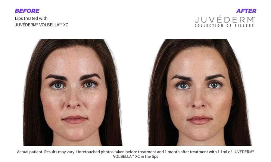Dermal-Fillers-before-and-after-Beauty-Bar-Clinics