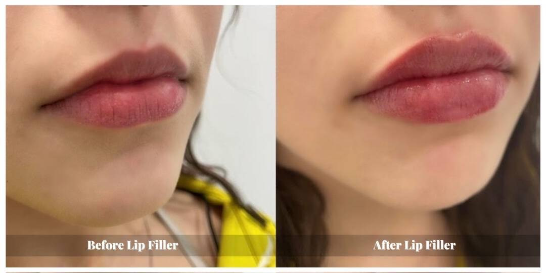 lip fillers before and after in waterloo kitchener cambridge