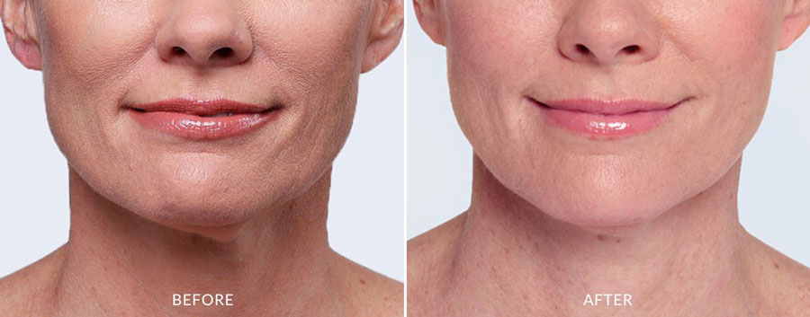 Restylane-Fillers-before-and-after-Beauty-Bar-Clinics-3
