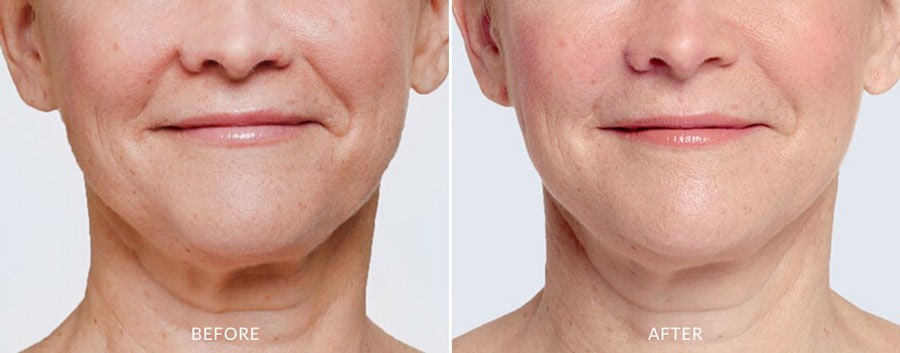 Restylane-Fillers-before-and-after-Beauty-Bar-Clinics-4