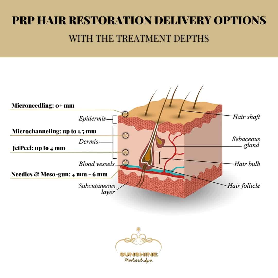Different delivery options and their treatment depths for PRP hair restoration in Kitchener Waterloo area, Ontario.