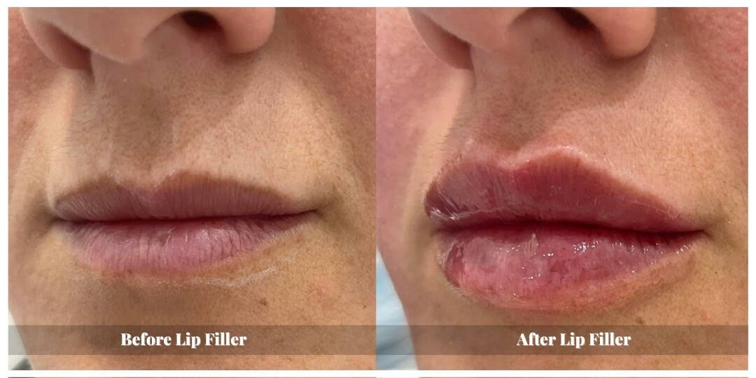 lip injections before and after in kitchener waterloo cambridge