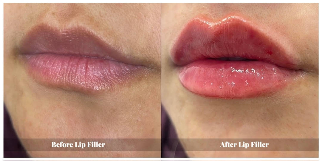 lip fillers before and after waterloo kitchener cambridge