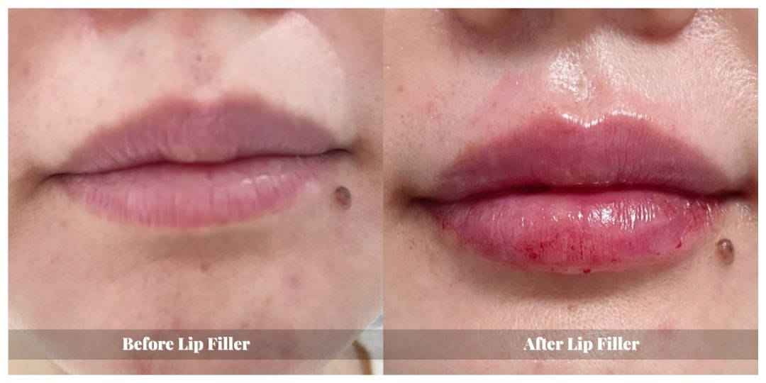 lip injections before and after kitchener waterloo cambridge