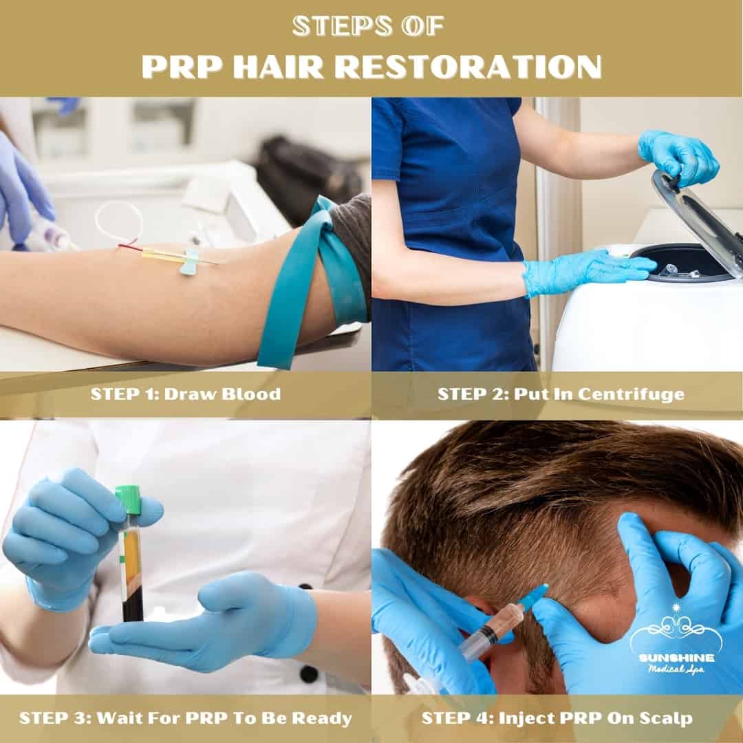 The 4 steps of PRP hair restoration treatment in Kitchener-Waterloo area.