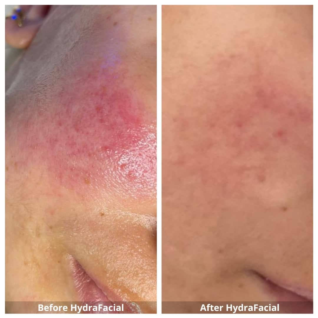 HydraFacial Waterloo, Kitchener, Cambridge HydraFacial Near Me