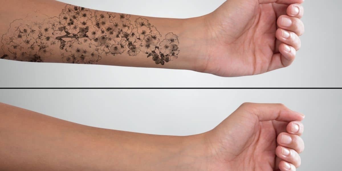 How to Speed Up the Result of Laser Tattoo Removal ?